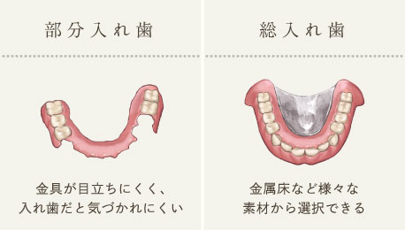 部分入れ歯：クラスプがないものなど自由に選択できる、総入れ歯：金属床など様々な素材から選択できる