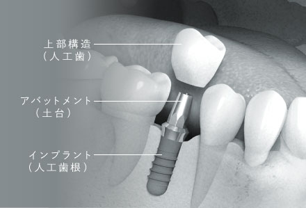 上部構造（人工歯）/アバットメント（土台）/インプラント（人工歯根）